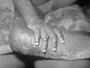 Monkeypox
