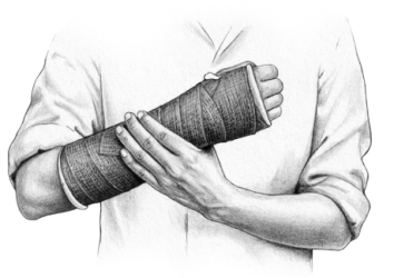 An illustration of a man holding a broken wrist in a cast.