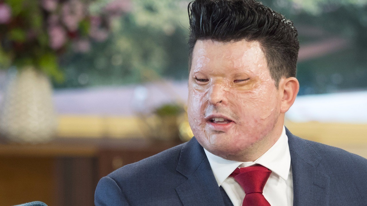 The Rise In Acid Attacks Attack Victim Tells Us Why Life Has To Mean