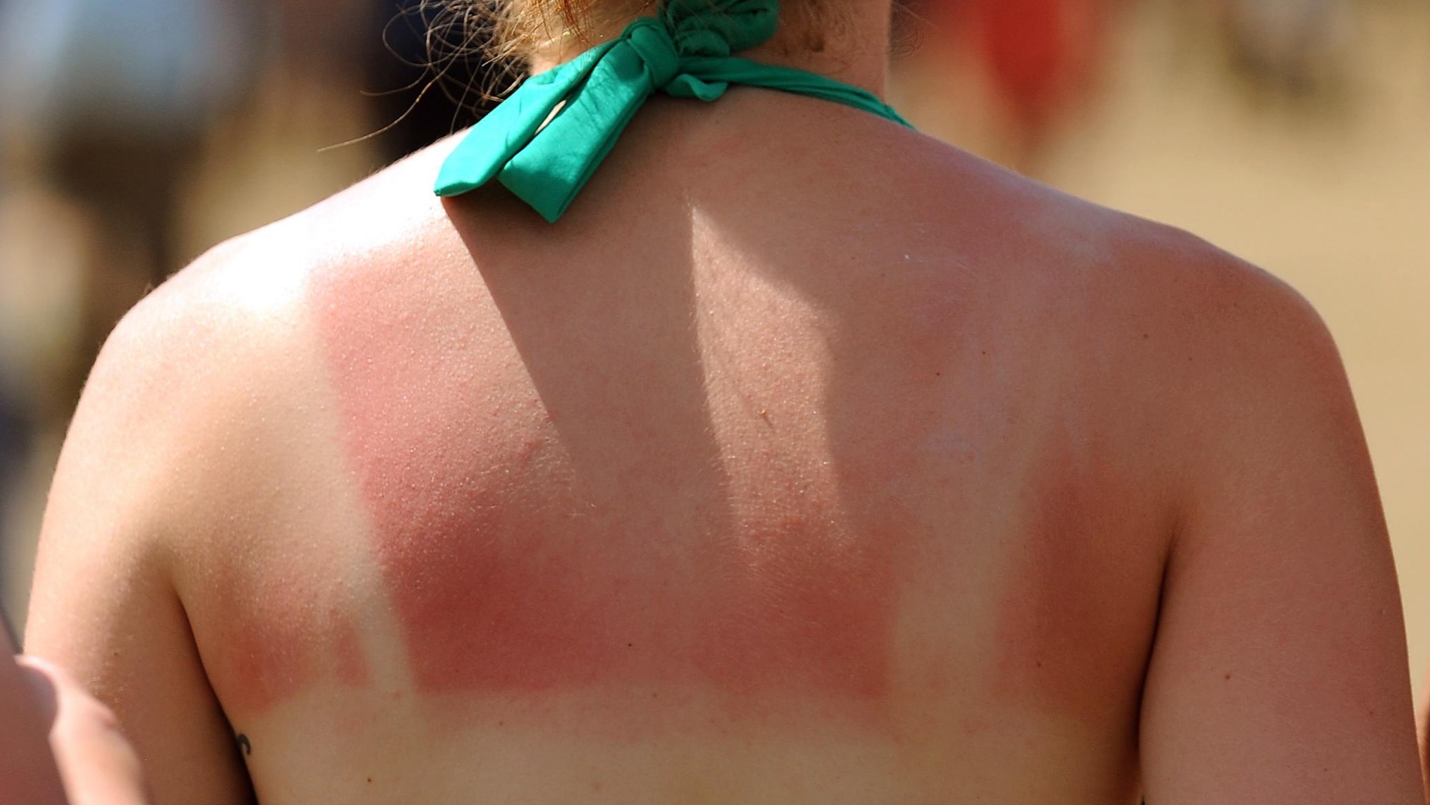 Image result for sunburn