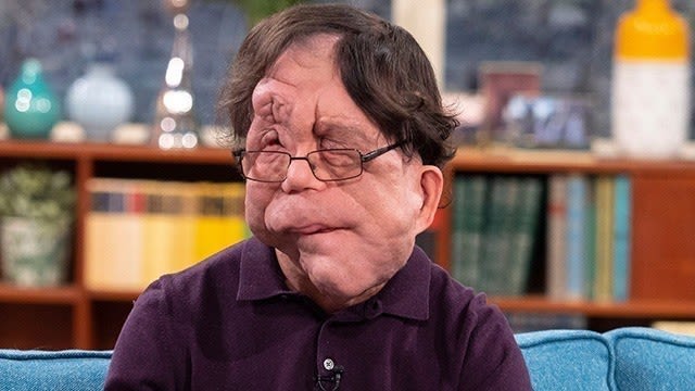 Adam Pearson Changing Perceptions Of Disfigurement This Morning