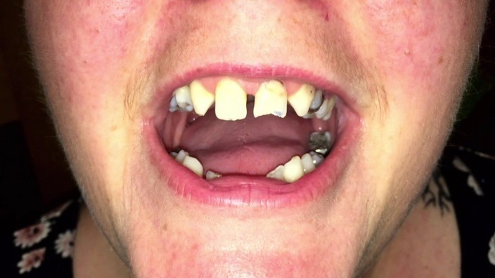 Fear of the dentist caused me to pull out my own teeth | This Morning