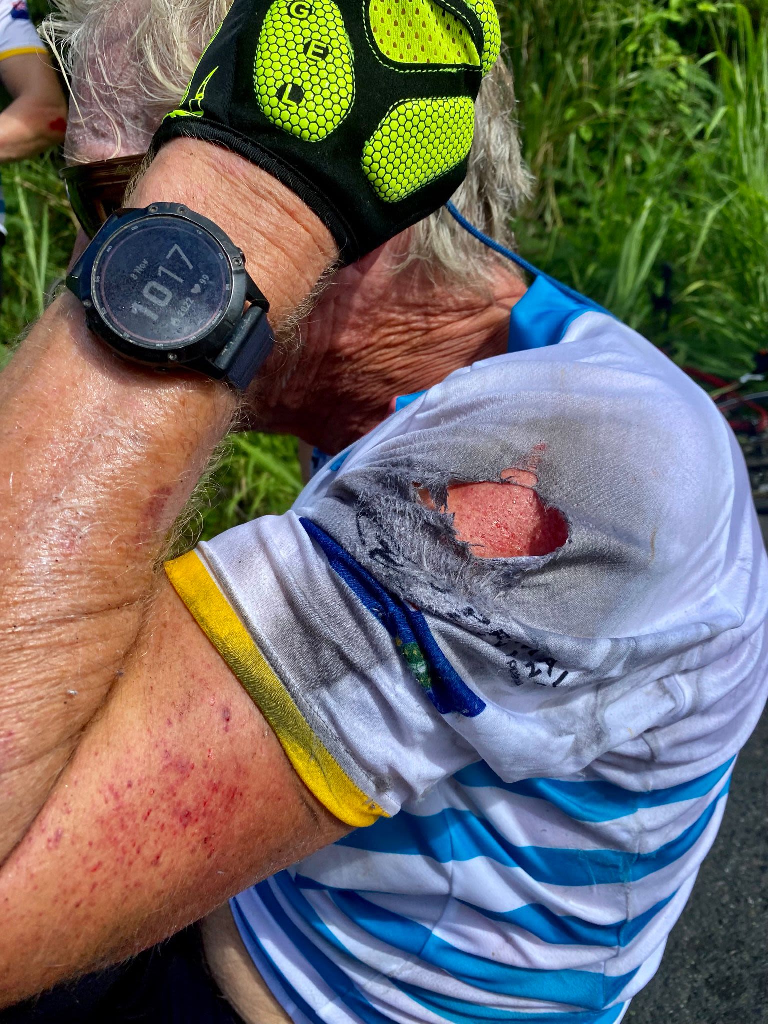 Richard Branson's injured arm following a bike crash on the 2021 Strive Challenge
