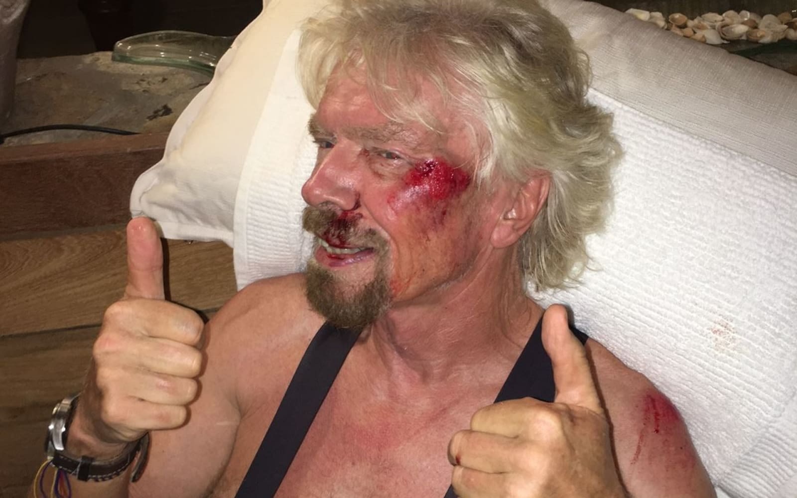 Richard Branson's injuries after his bike accident