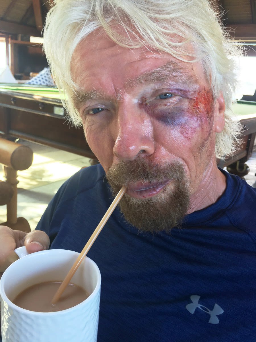 Richard Branson drinks tea from a straw following a bike accident in 2016