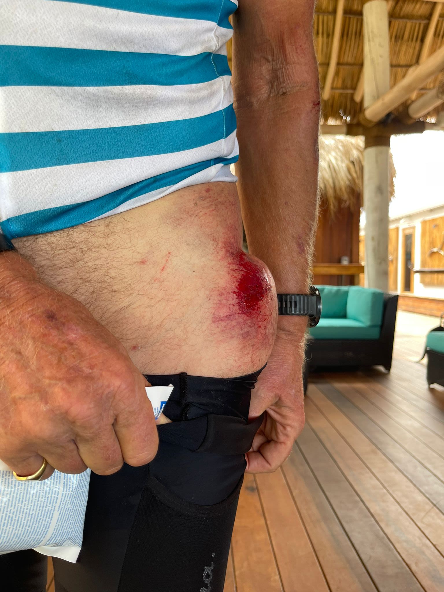 Richard Branson's injury from a bike crash on the 2021 Strive Challenge