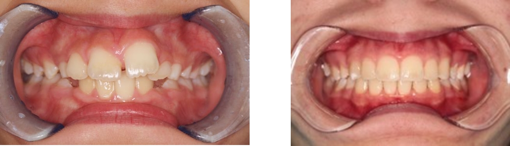 Orthodontics before/after 