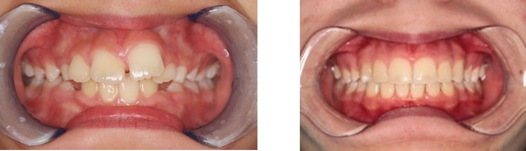 Orthodontics before/after