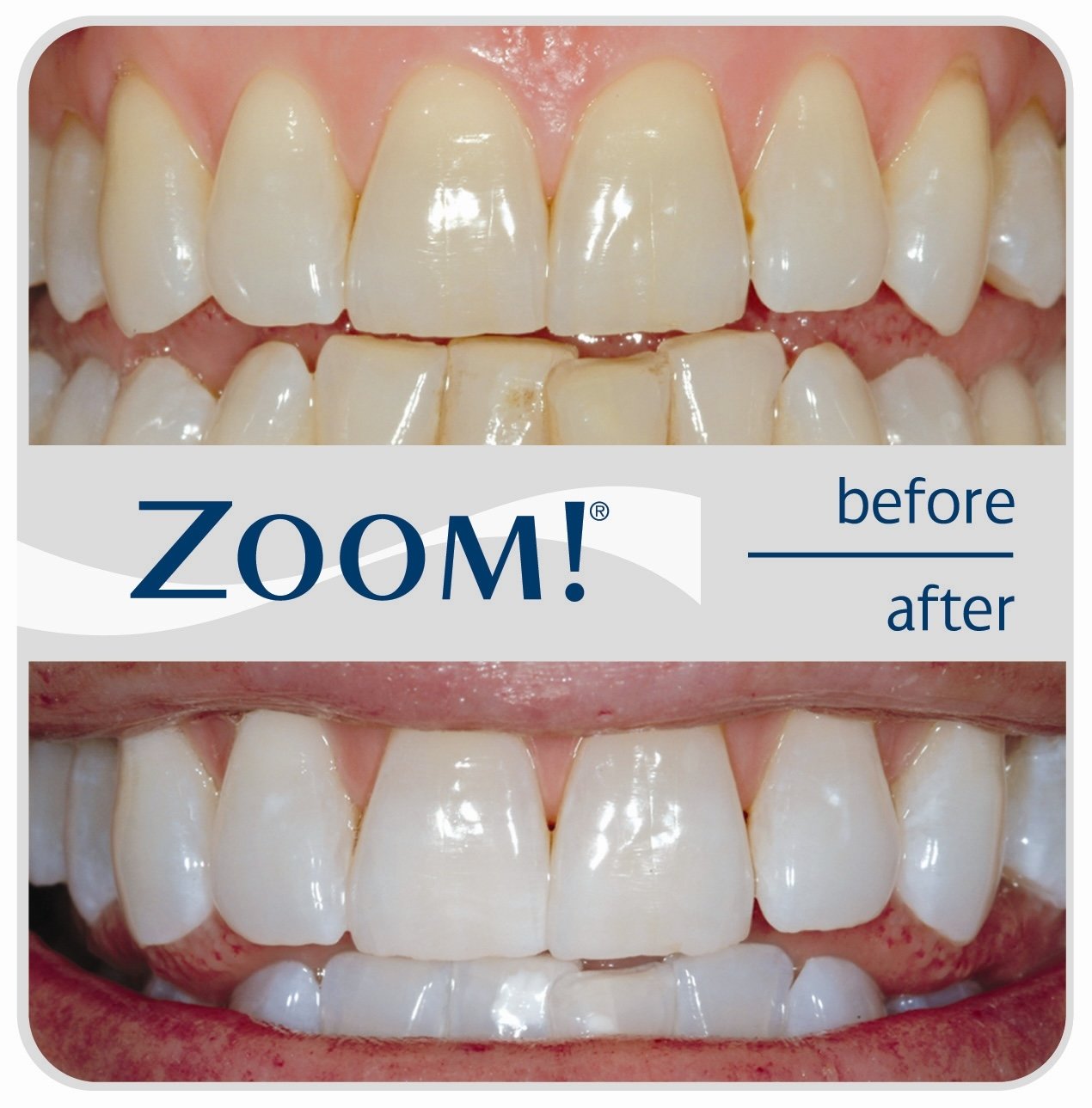 Before and after whitening with Zoom logo