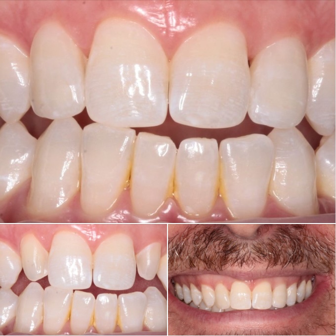 A composite image of three veneers