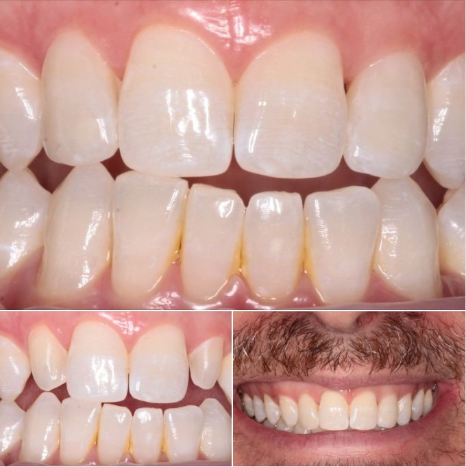 A composite image of three veneers