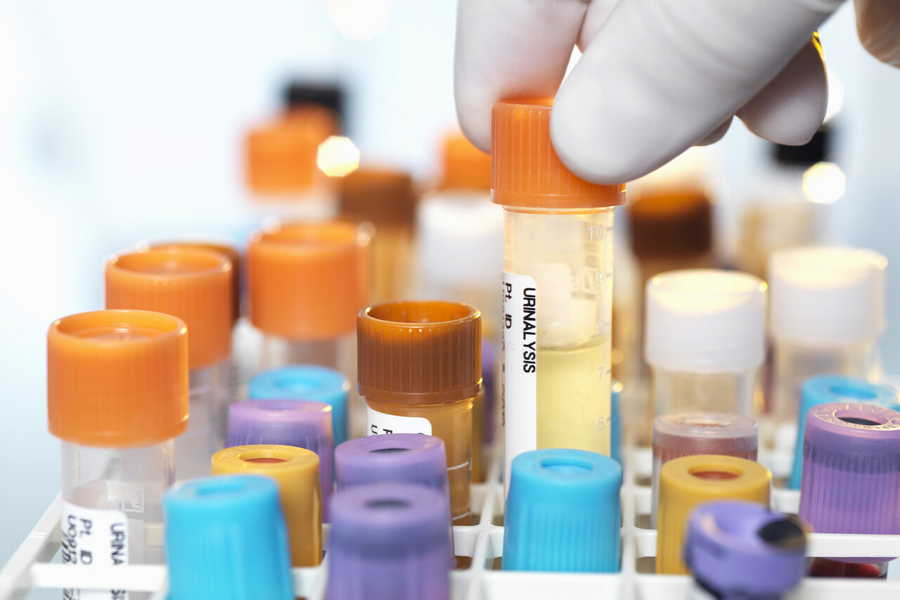 Excessive Vitamin C Loss via Renal Leak More Common in Women Living