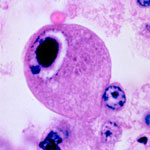 Canadian Researchers Point to CMV as a Problem for the Immune System