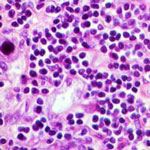Current and Future Therapies for CMV