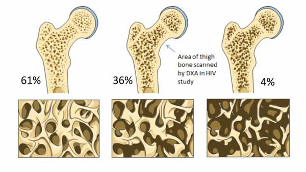 Osteoporosis and Smoking Raise Fracture Risk in People With HIV