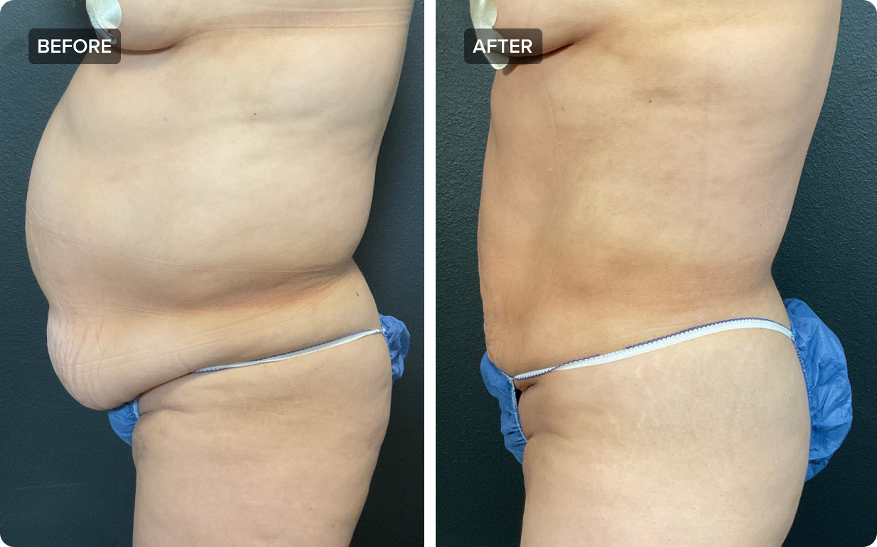 Tummy Tuck vs. Liposuction: What's the difference?