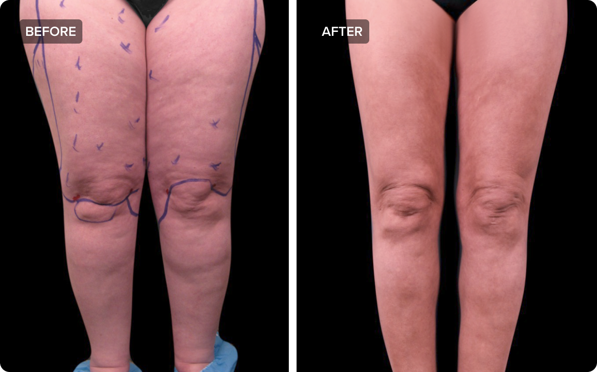 Lipedema Legs or Just Fat Legs? Crucial Things to Know - Salameh Plastic  Surgery Center