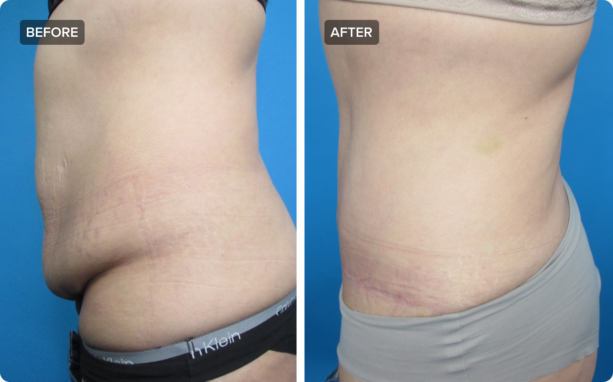 Tummy Tuck Surgery: The Ultimate Guide to Abdominoplasty