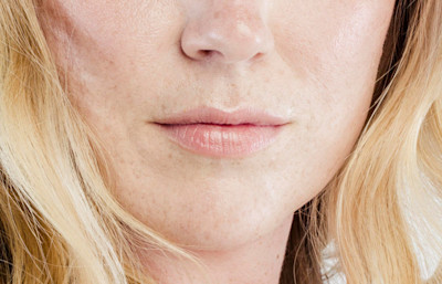 How Long Does Juvederm Voluma Last?   WIFH