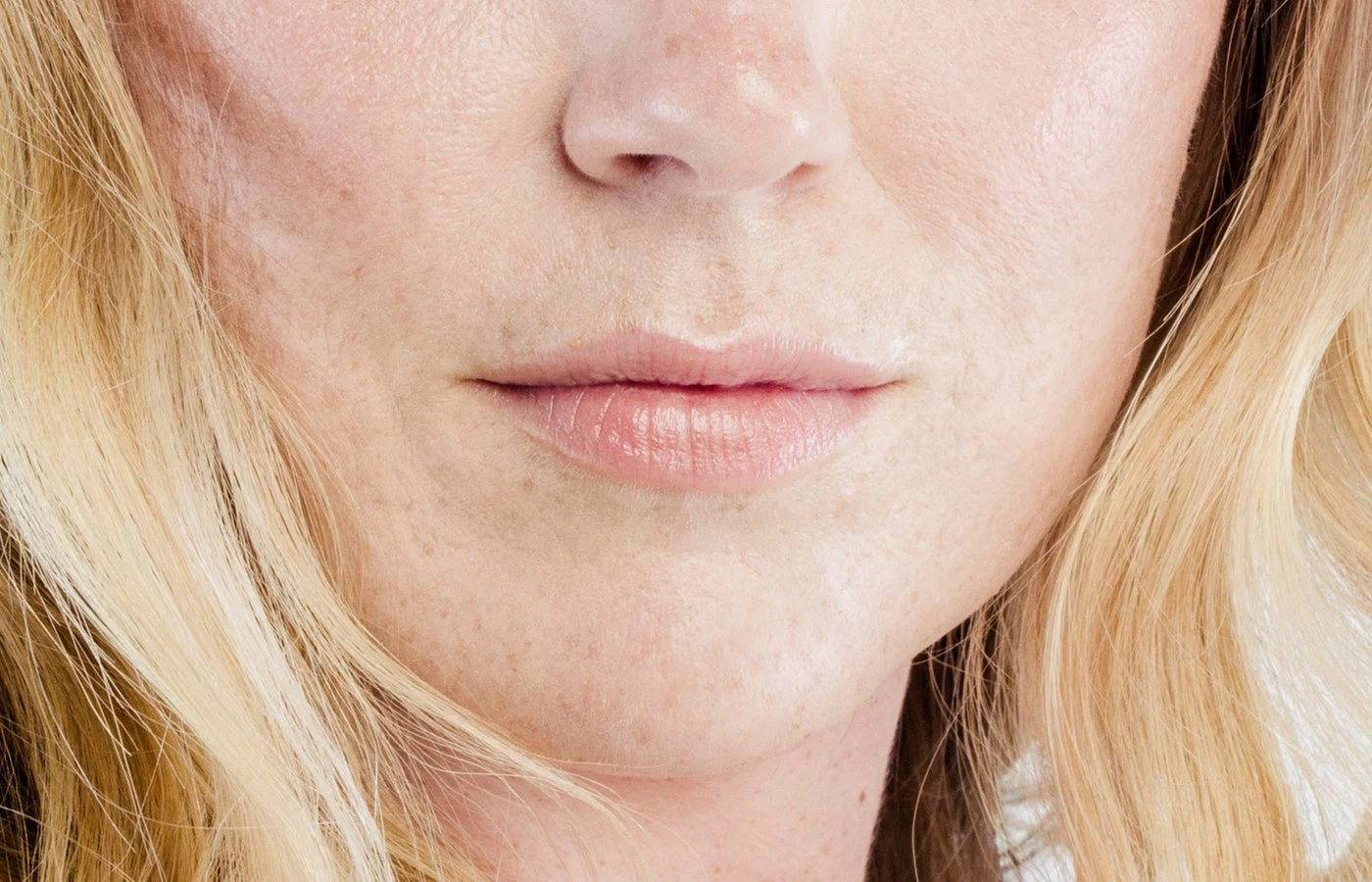 Juvederm (Page Image)