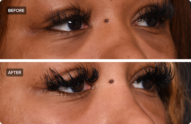 Prp Injection Photos What Are PRP Injections and How Much Do They Cost? | RealSelf