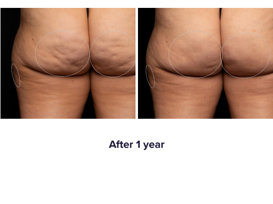 Qwo Cellulite Removal Injections Sale - $1900 Near Me in NJ
