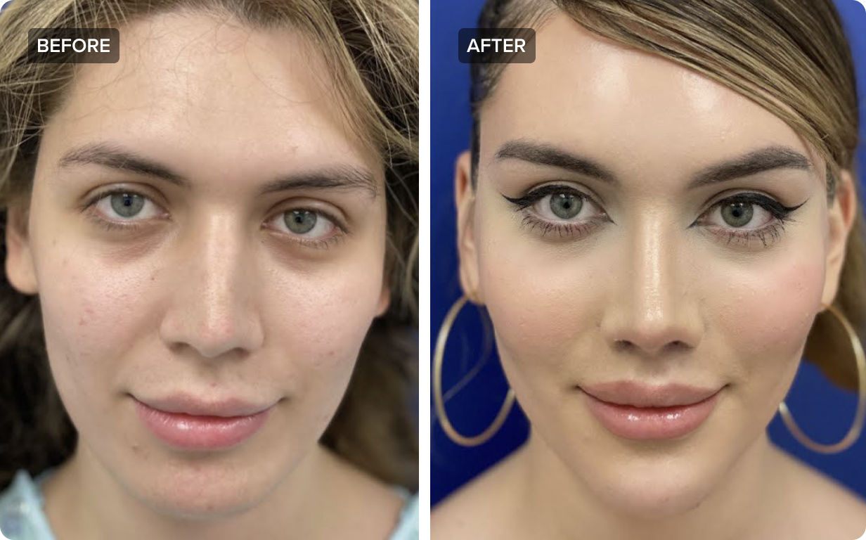 Jaw Reduction in Facial Feminization Surgery for Transwomen