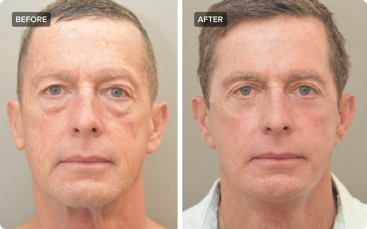 Deep Plane Facelift Procedure, Cost, Recovery