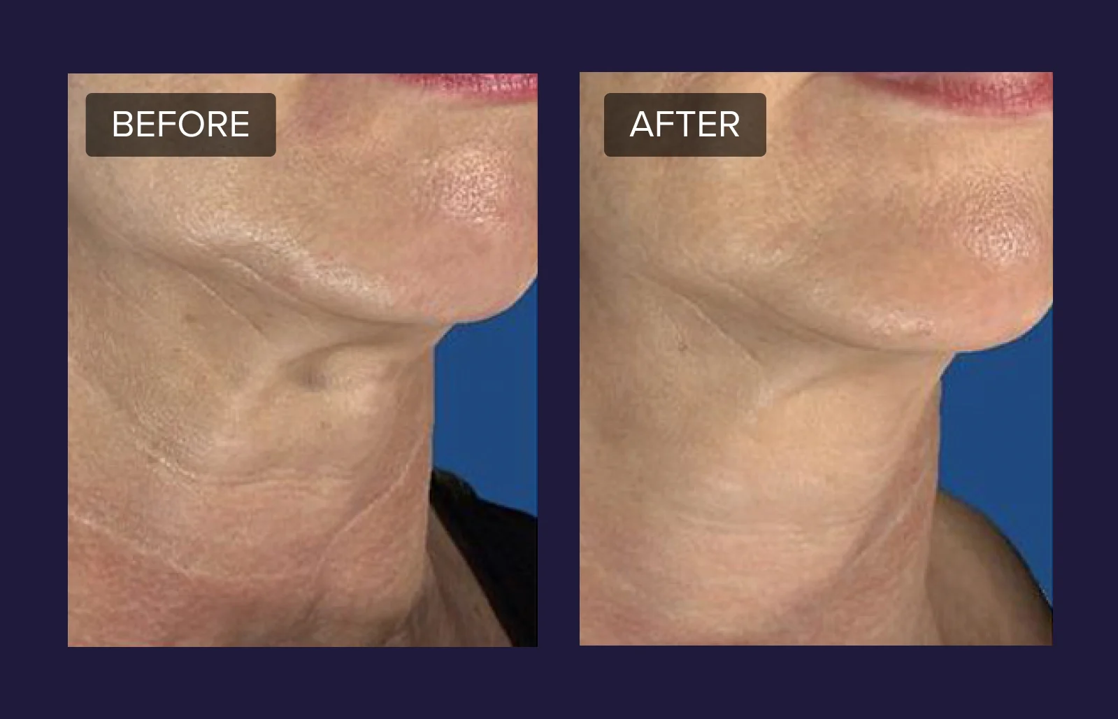 RF-Microneedling B-A Mobile