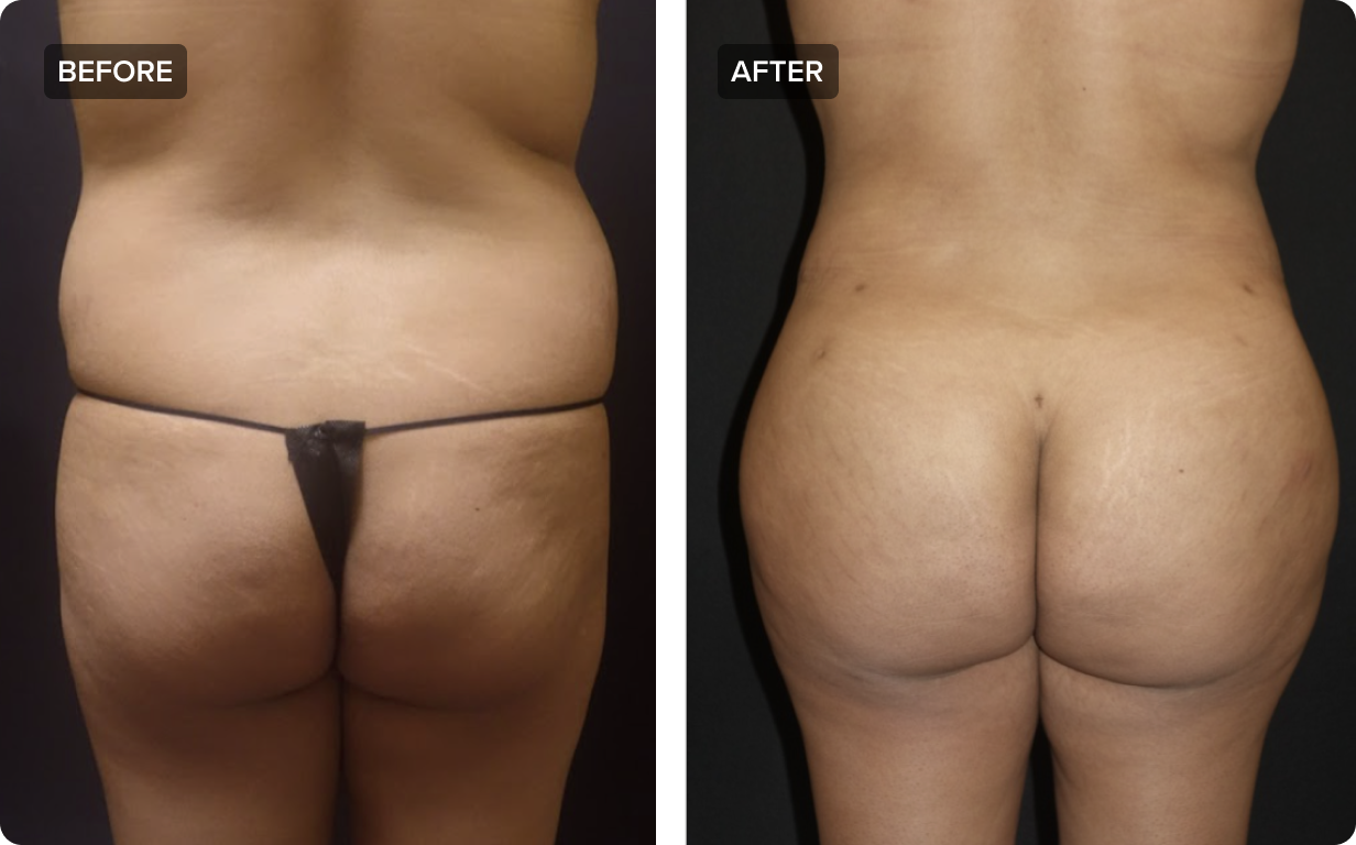 Brazilian Butt Lift Procedure in Plano TX - Buttock Enhancement