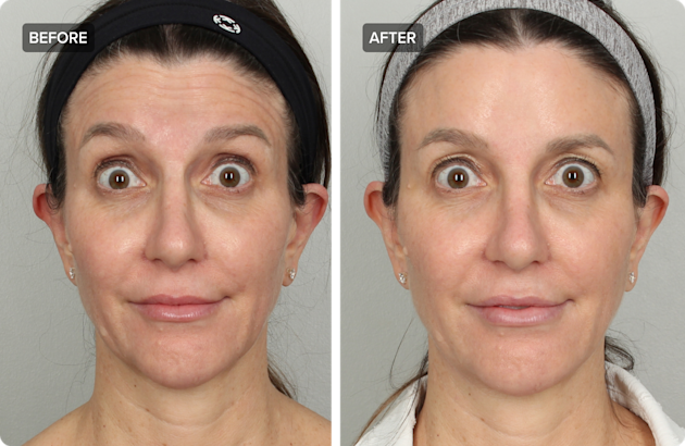 Daxxify Fall Daxxify: Is This New Neurotoxin Better Than Botox? | RealSelf