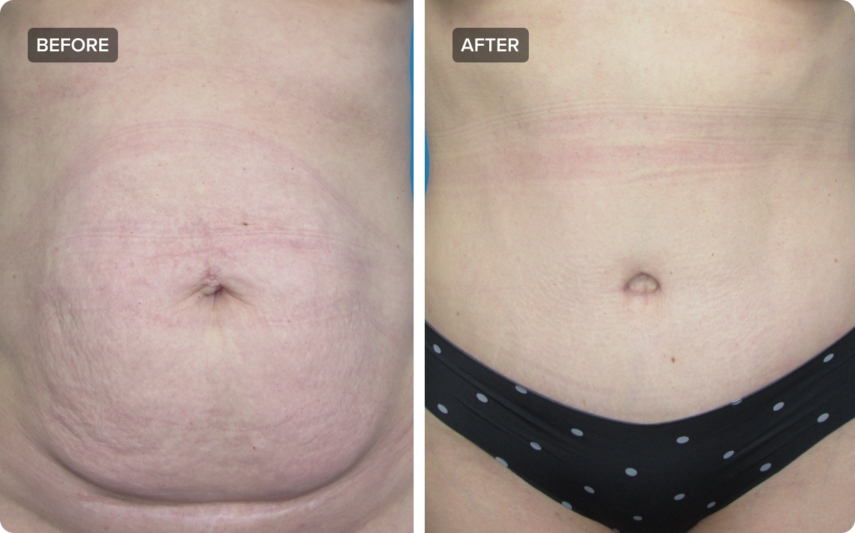 How Long Does It Take to Recover from Tummy Tuck? - George P