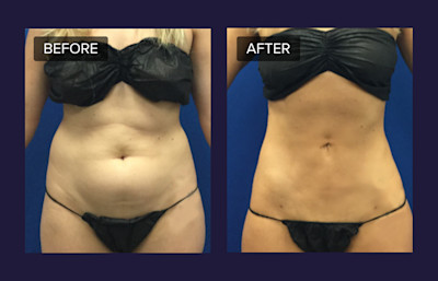 laser lipo after c section Can get rid of a belly bulge or belly pooch? Or do you have to do a tummy tuck to get rid of the C-section shelf? Real Talk from a femae plastic surgeon with actual #beforeandafter pics Smart Lipo 360| Liposuction| Before