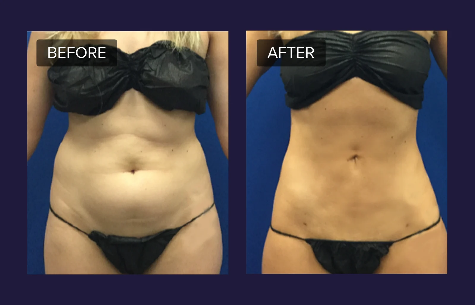 LaserLiposuction B-A Mobile