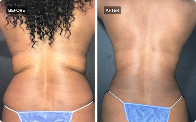 melanotan 2 reconstitution calculator Avoiding Trendy Lipo: Why Elegant Lipo Is Better by Dr. John Burns – Dr  John Burns
