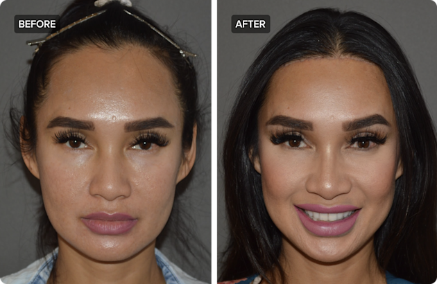 Reducing Forehead Forehead Reduction: Your Guide to Hairline Lowering | RealSelf