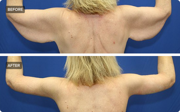 What's the Best Treatment for Flabby Arms?, Tucson Arm Lift