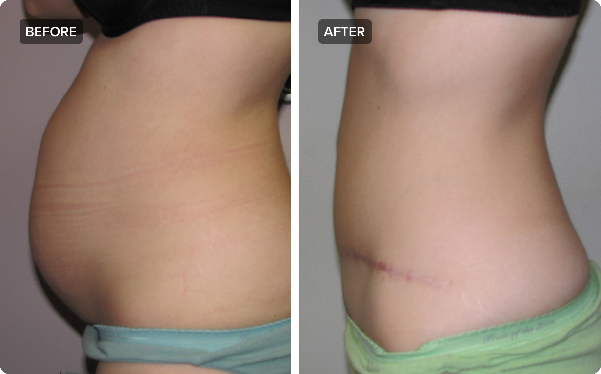 How Long Is Recovery After a Tummy Tuck? - Bachelor, Eric  ()
