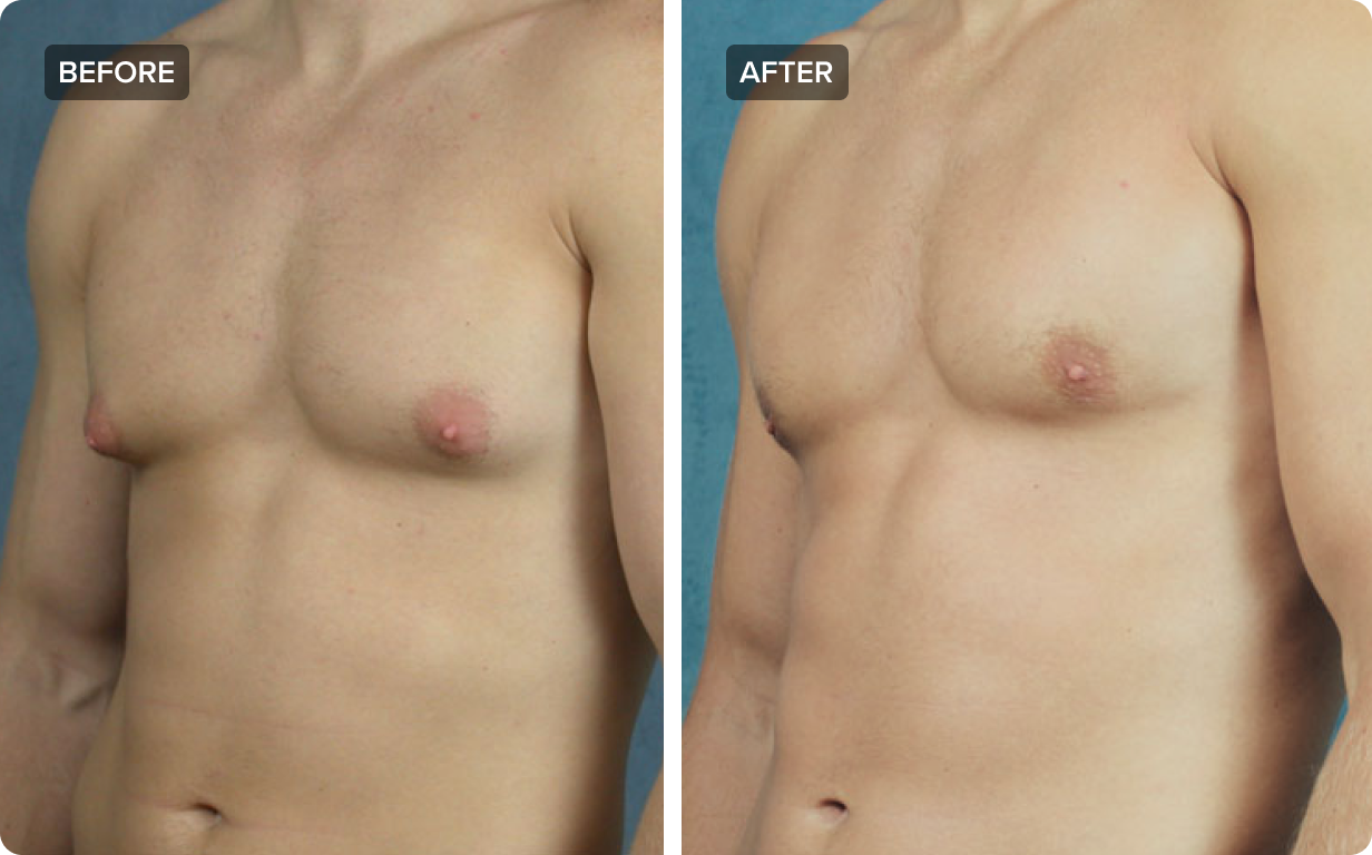 60 Years Old Small Tits - Gynecomastia Surgery: The Truth About Male Breast Reduction