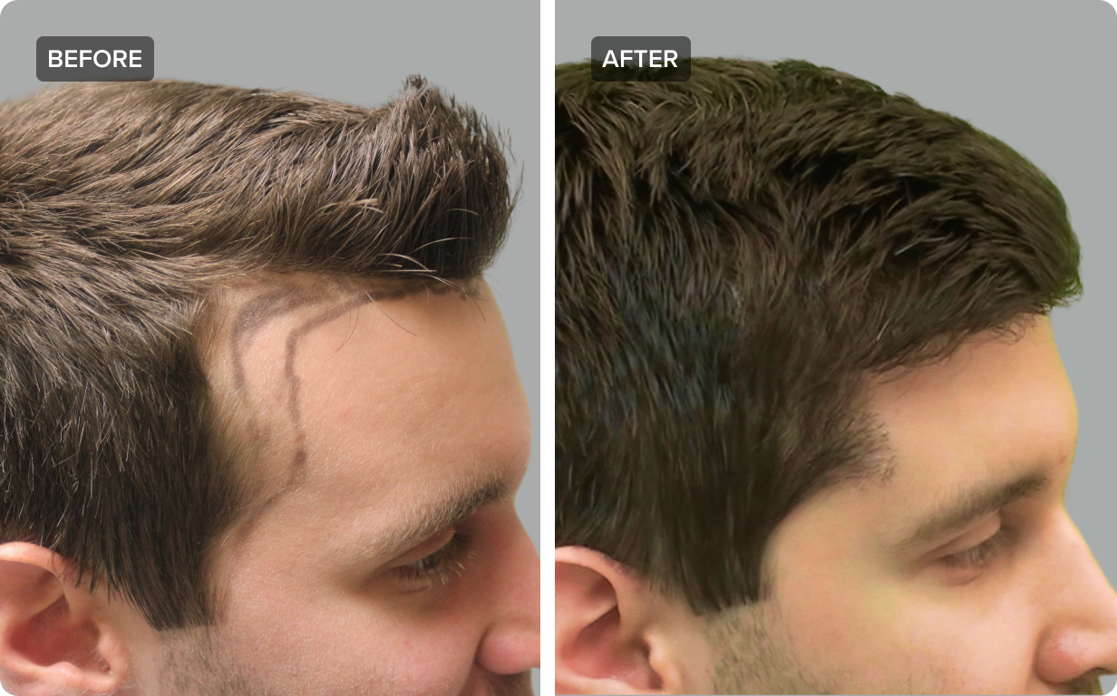 FUE Hair Transplant What to Expect Cost Pictures and More