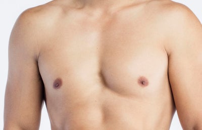 Enlarged breasts in men (gynecomastia) - Symptoms and causes - Mayo Clinic