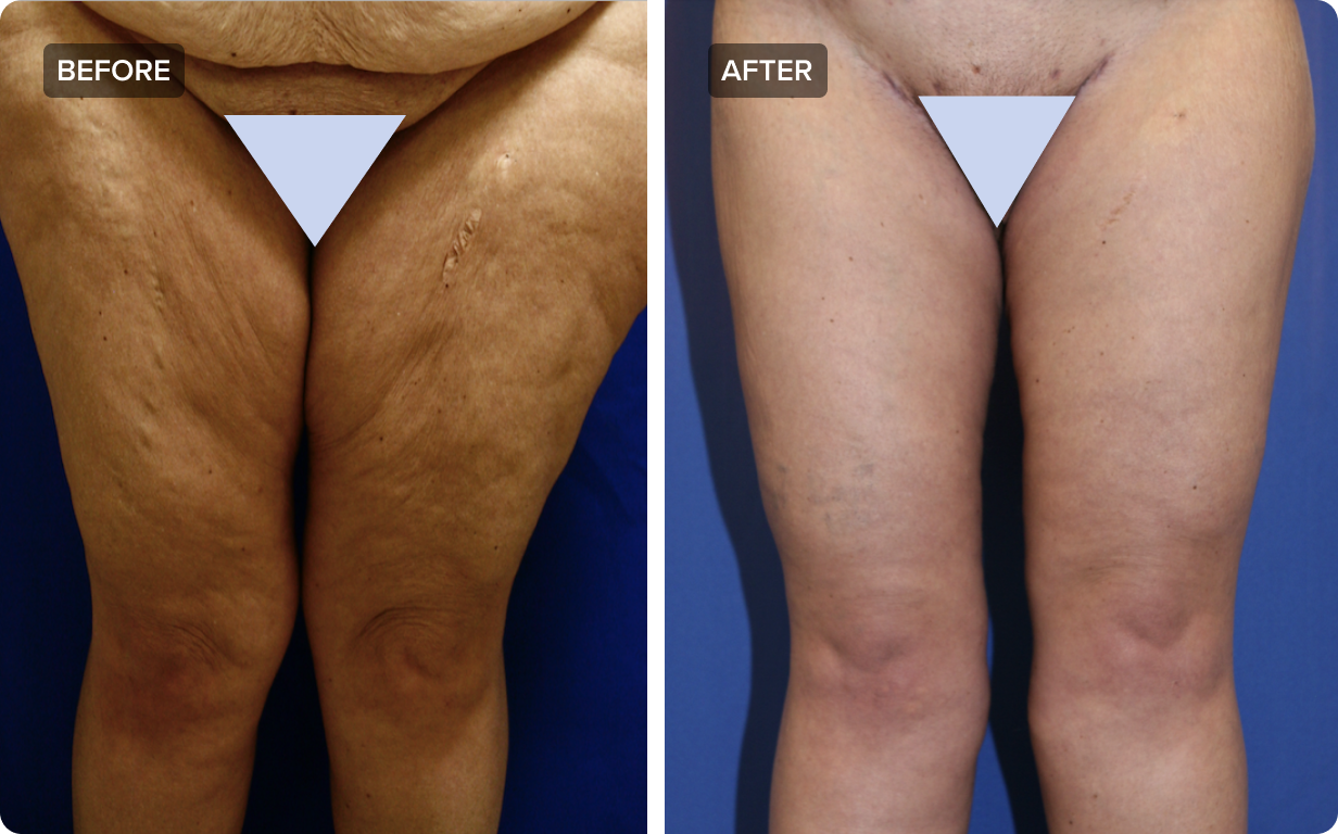 Scar on left inner thigh from operation to remove a high grade