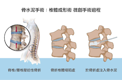 聯創愛凱福骨水泥取得 TFDA 二類核准