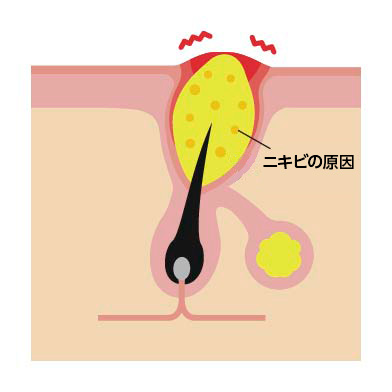 皮膚の専門家が監修「ニキビ集中ケアコース」 - Image 9 - ci-z.com - ja-JP