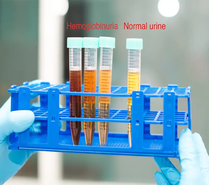 G6PD hemoglobinuria