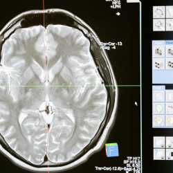 skurcze-miesni-jakie-sa-przyczyny-neurologiczne