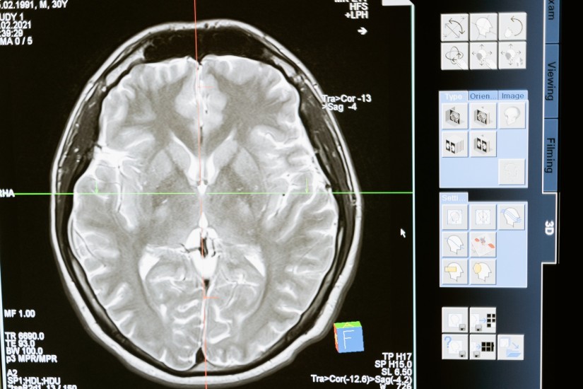 skurcze-miesni-jakie-sa-przyczyny-neurologiczne