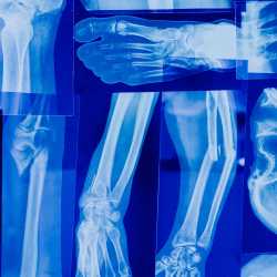 badania-na-osteoporoze-jak-wyglada-na-czym-polega