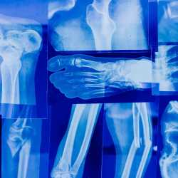 badania-na-osteoporoze-jak-wyglada-na-czym-polega