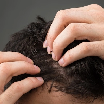 Перхоть и выпадение волос